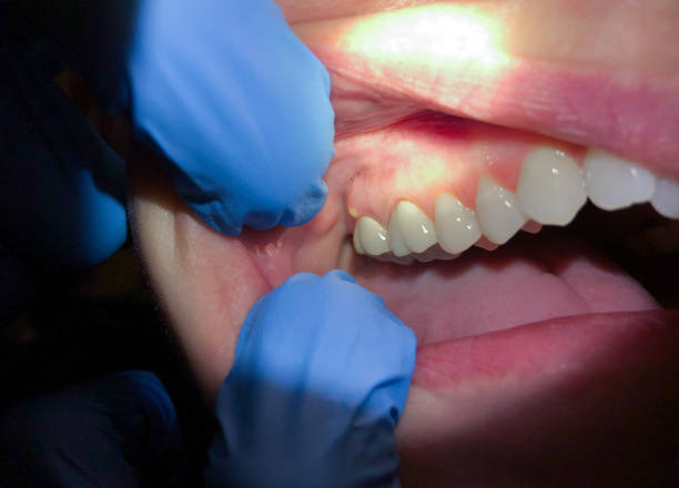 Best Emergency Dental Care for Broken or Chipped Teeth in Morrisville, PA
